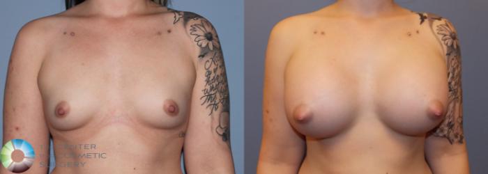 Before & After Breast Augmentation Case 757 View #1 in Denver, CO