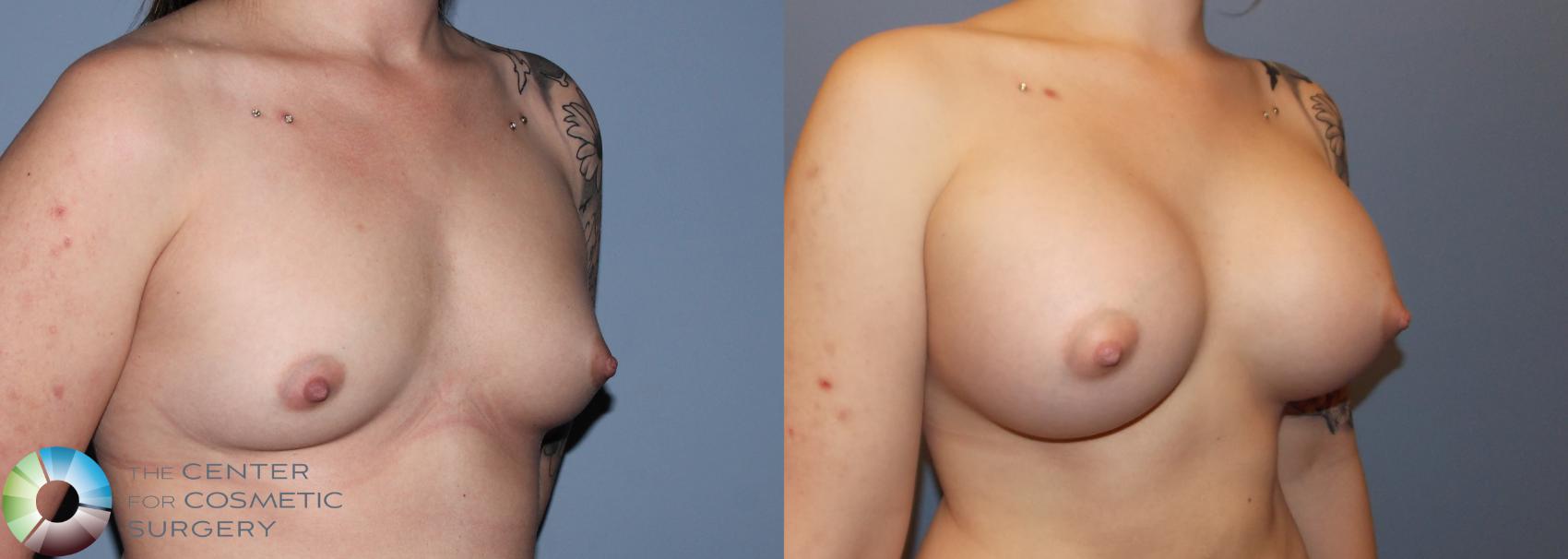 Before & After Breast Augmentation Case 757 View #2 View in Golden, CO