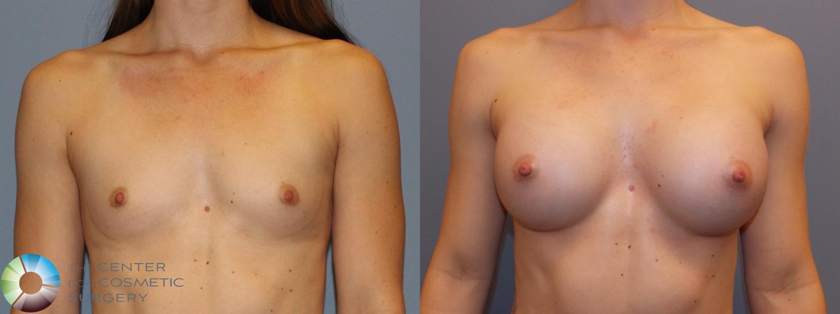 Before & After Breast Augmentation Case 758 View #1 in Denver and Colorado Springs, CO