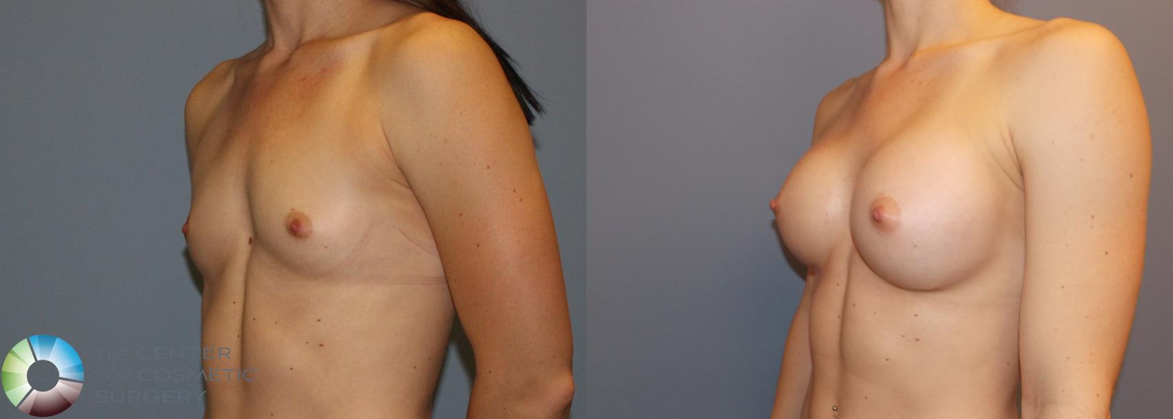 Before & After Breast Augmentation Case 758 View #2 View in Golden, CO