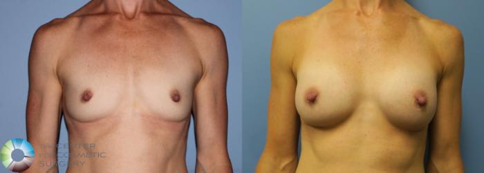 Before & After Breast Augmentation Case 759 View #1 in Denver and Colorado Springs, CO