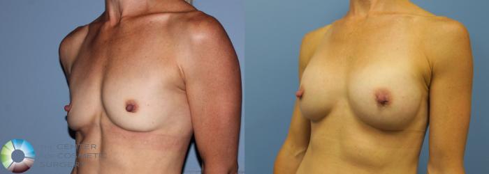 Before & After Breast Augmentation Case 759 View #2 in Denver and Colorado Springs, CO