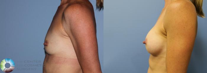 Before & After Breast Augmentation Case 759 View #3 in Denver and Colorado Springs, CO