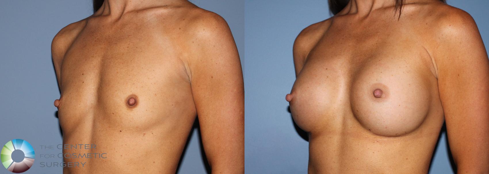 Before & After Breast Augmentation Case 760 View #1 in Denver and Colorado Springs, CO