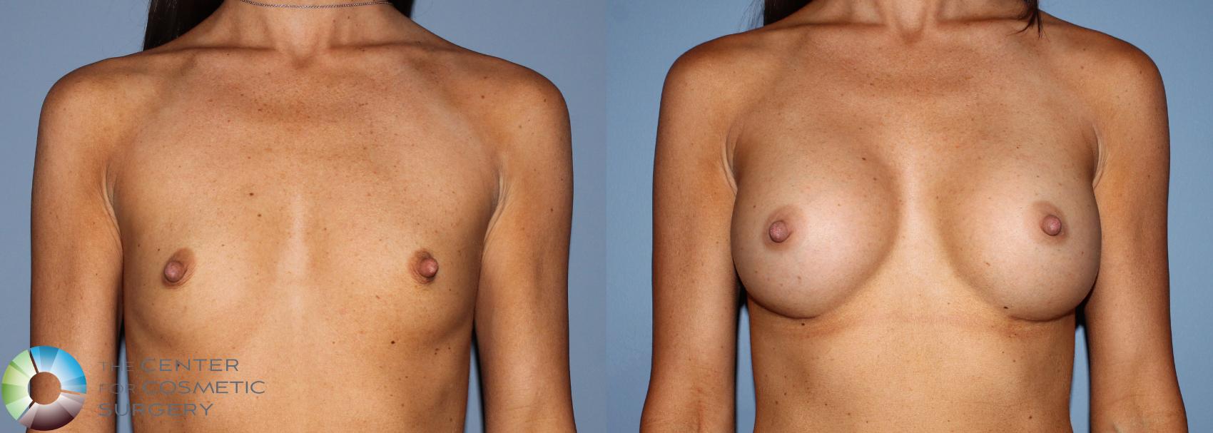 Before & After Breast Augmentation Case 760 View #3 View in Golden, CO