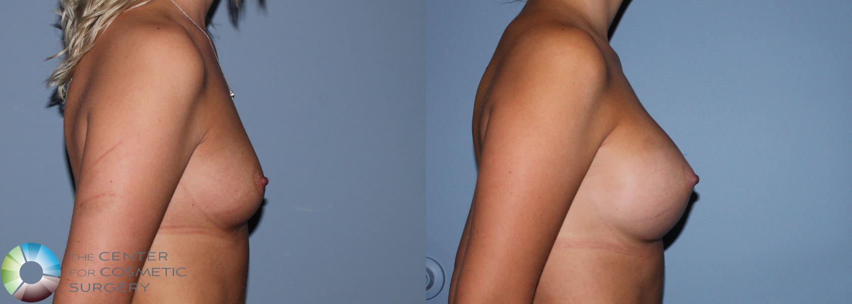 Before & After Breast Augmentation Case 761 View #1 in Denver and Colorado Springs, CO