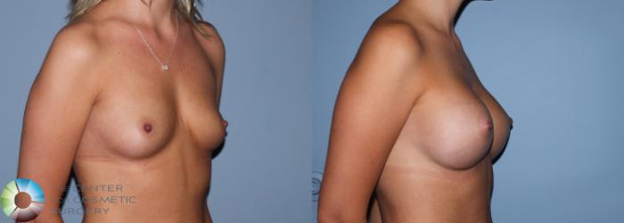 Before & After Breast Augmentation Case 761 View #2 in Denver and Colorado Springs, CO