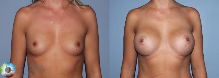 Before & After Breast Augmentation Case 761 View #3 in Denver and Colorado Springs, CO