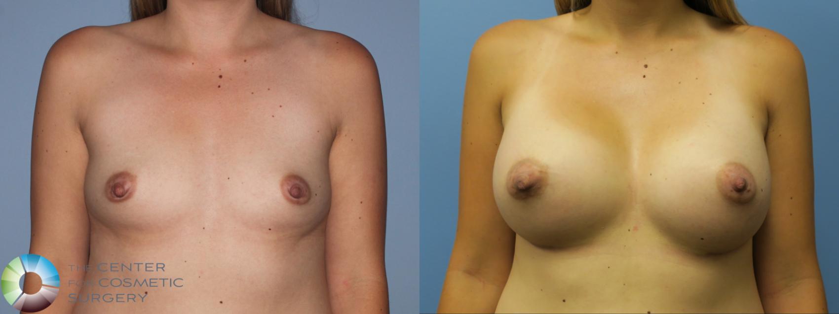 Before & After Breast Augmentation Case 762 View #1 in Denver and Colorado Springs, CO