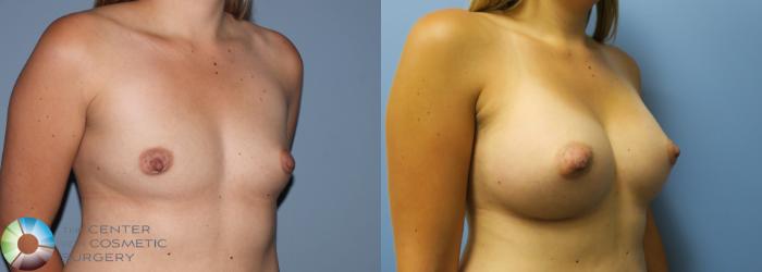 Before & After Breast Augmentation Case 762 View #2 View in Golden, CO