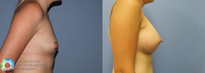 Before & After Breast Augmentation Case 762 View #3 View in Golden, CO