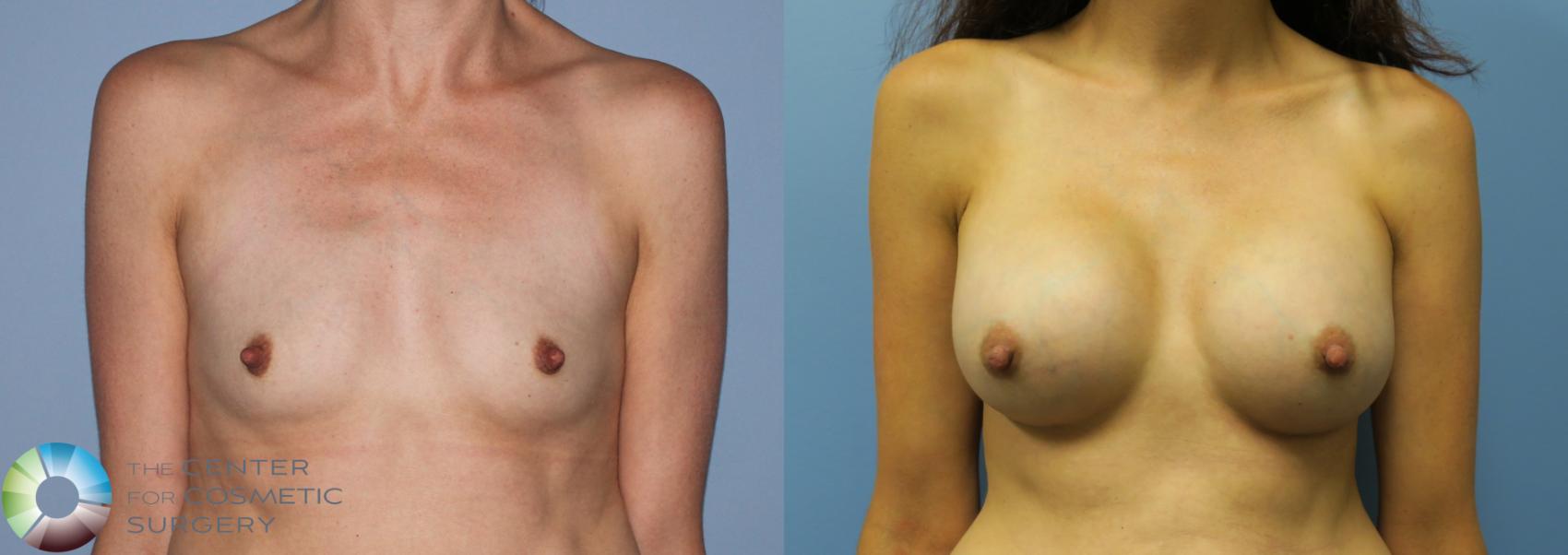 Before & After Breast Augmentation Case 763 View #1 in Denver and Colorado Springs, CO