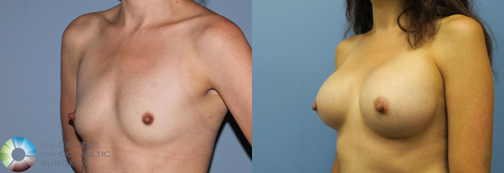 Before & After Breast Augmentation Case 763 View #2 View in Golden, CO
