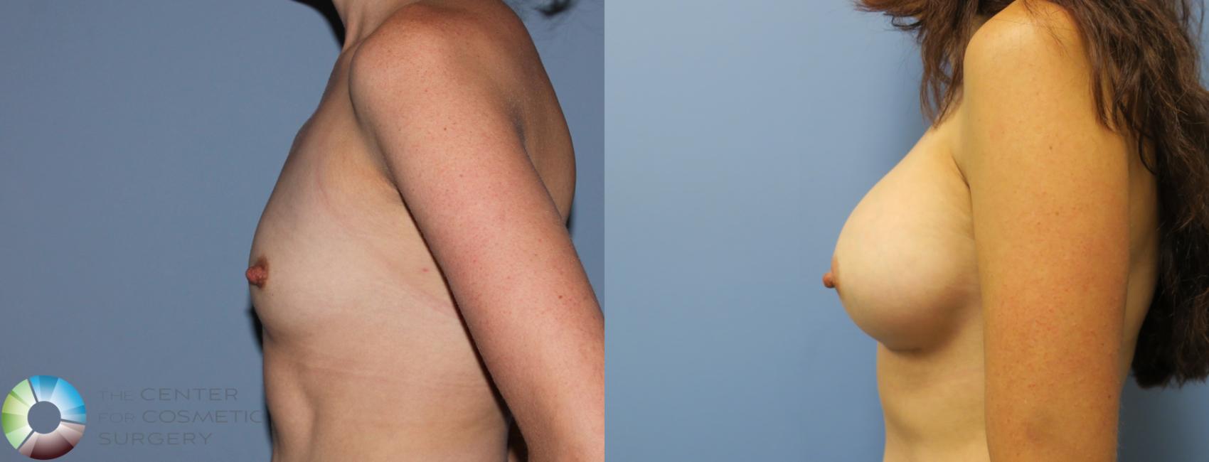 Before & After Breast Augmentation Case 763 View #3 View in Golden, CO
