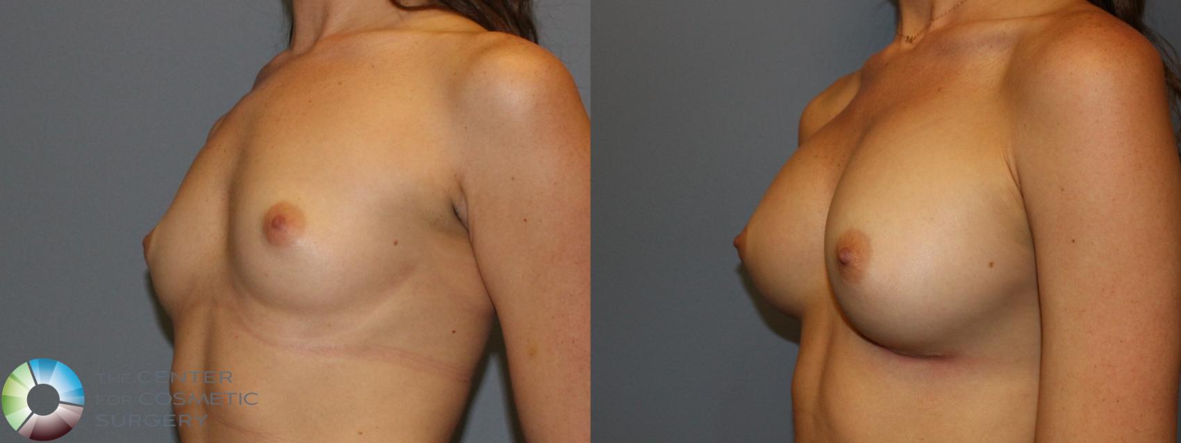 Before & After Breast Augmentation Case 779 View #1 in Denver and Colorado Springs, CO