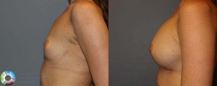 Before & After Breast Augmentation Case 779 View #2 View in Golden, CO
