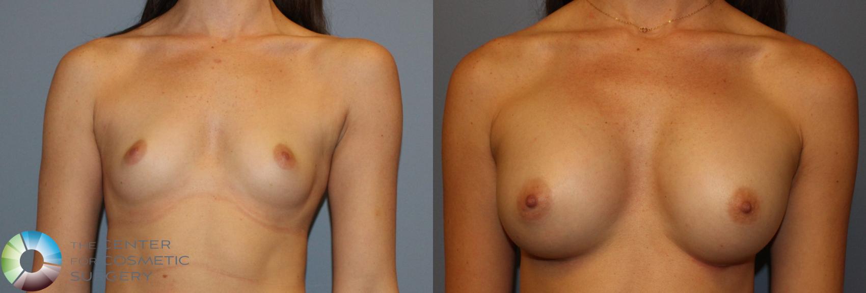 Before & After Breast Augmentation Case 779 View #3 View in Golden, CO
