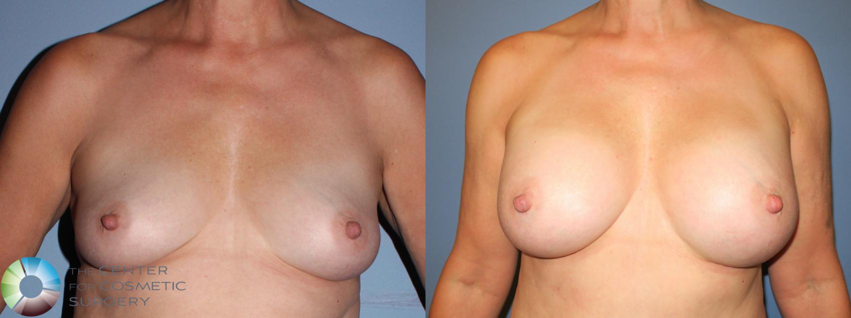 Before & After Breast Augmentation Case 801 View #1 in Denver and Colorado Springs, CO