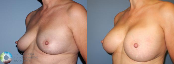 Before & After Breast Augmentation Case 801 View #2 View in Golden, CO