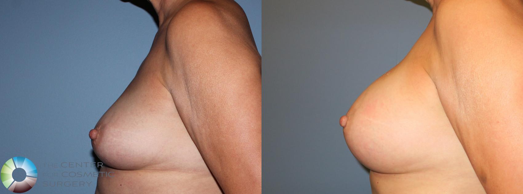 Before & After Breast Augmentation Case 801 View #3 View in Golden, CO