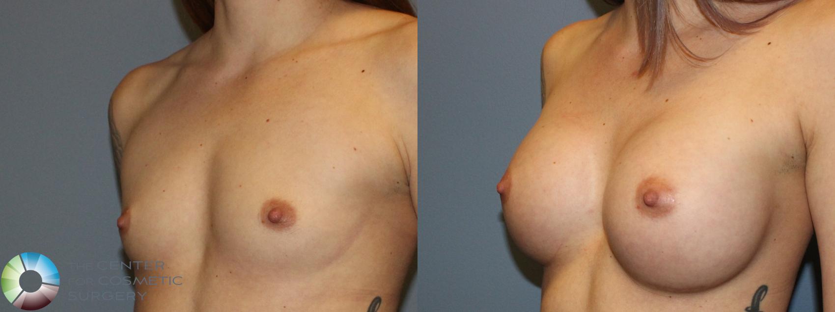 Before & After Breast Augmentation Case 802 Left Oblique in Denver and Colorado Springs, CO