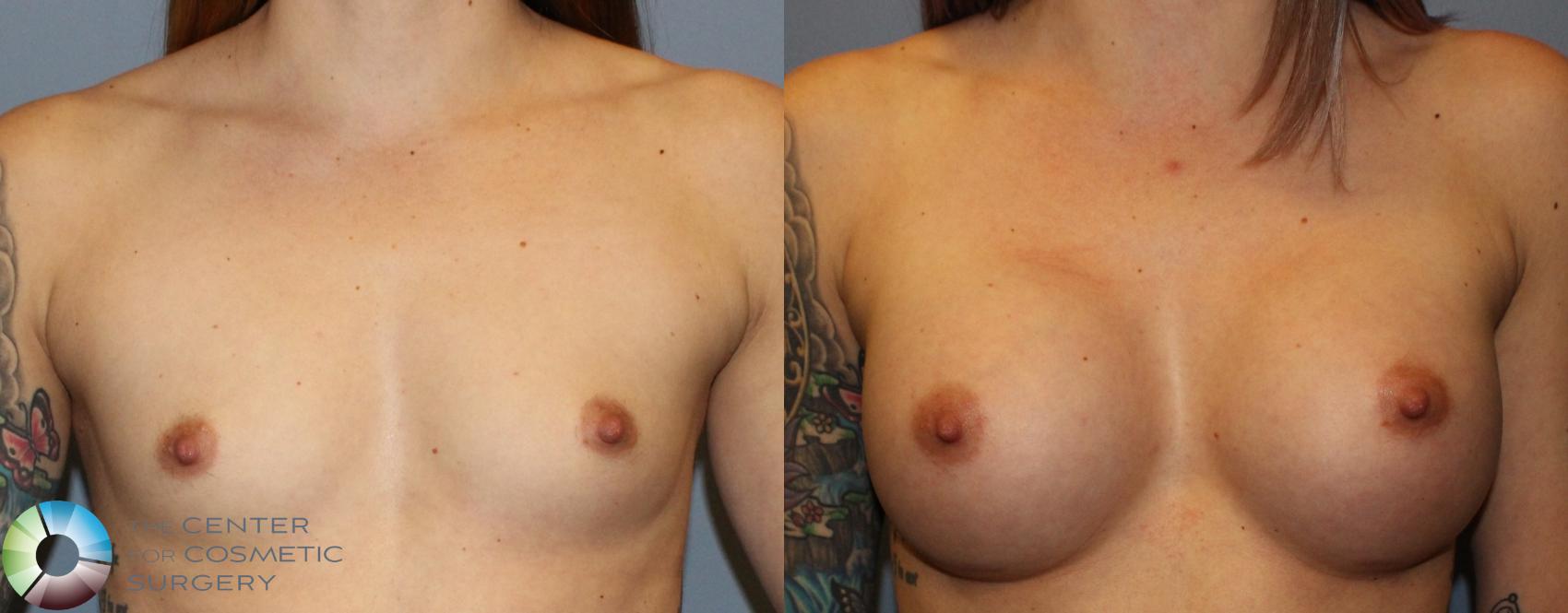 Before & After Breast Augmentation Case 802 View #1 in Denver and Colorado Springs, CO