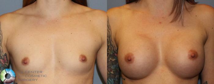 Before & After Breast Augmentation Case 802 View #1 View in Golden, CO
