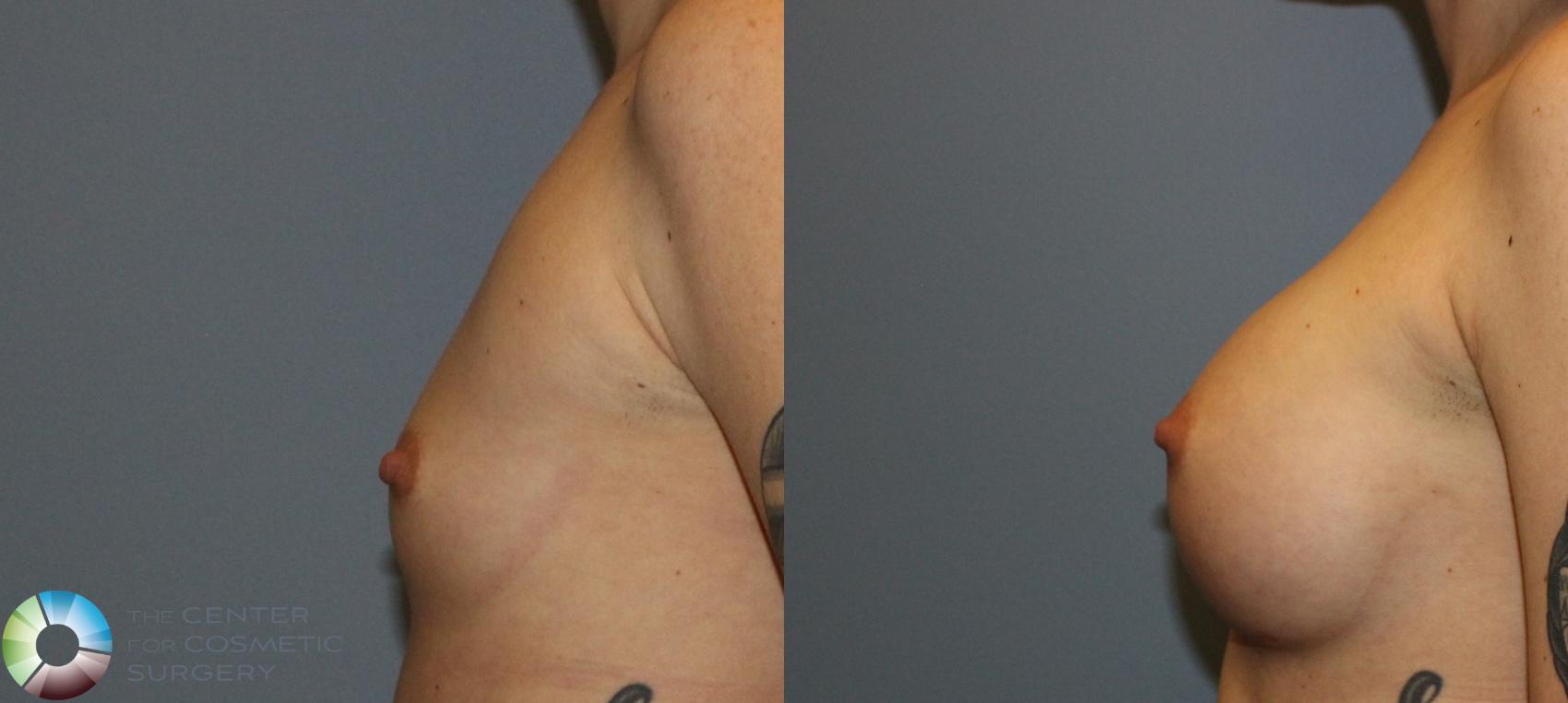 Before & After Breast Augmentation Case 802 View #3 in Denver and Colorado Springs, CO