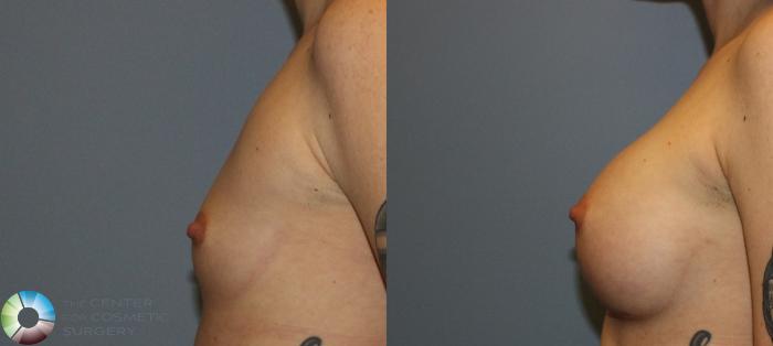 Before & After Breast Augmentation Case 802 View #3 View in Golden, CO