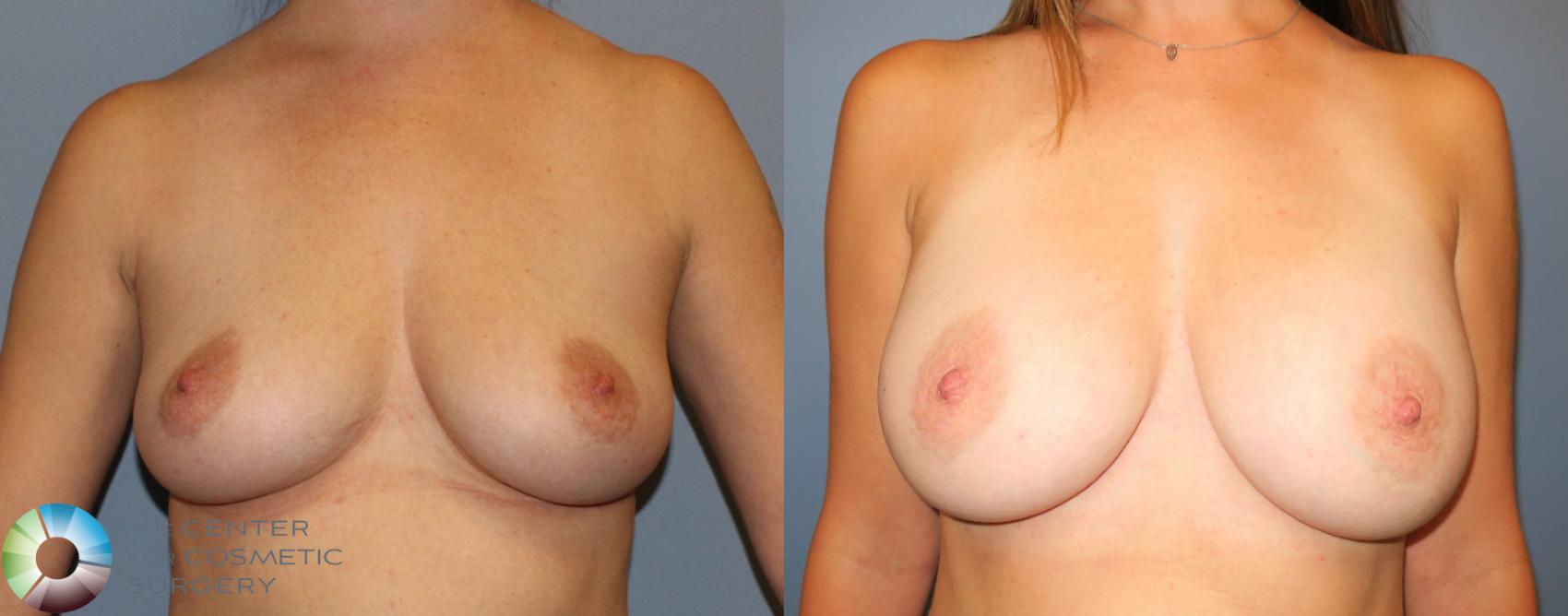 Before & After Breast Augmentation Case 803 View #1 in Denver and Colorado Springs, CO