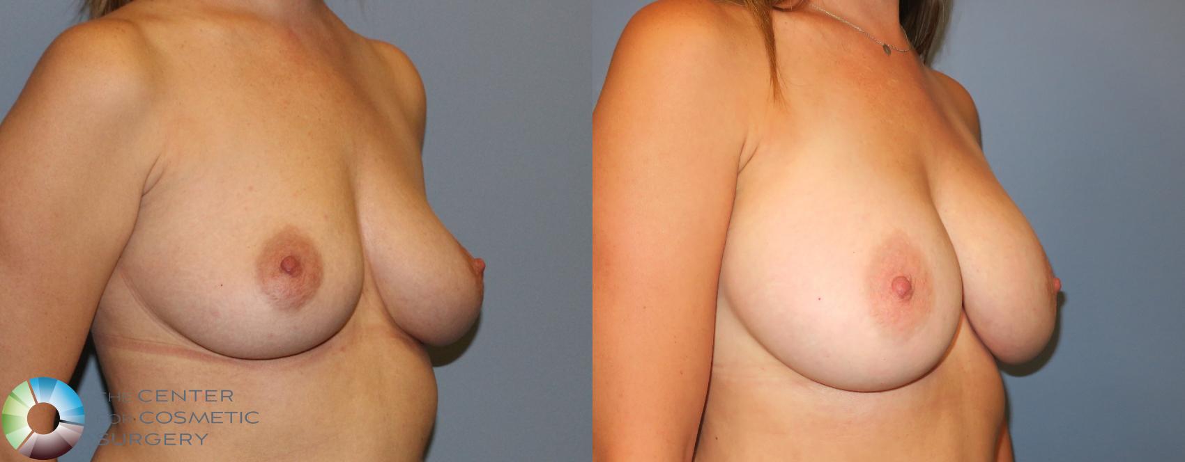Before & After Breast Augmentation Case 803 View #2 in Denver and Colorado Springs, CO