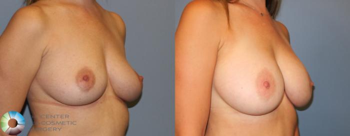 Before & After Breast Augmentation Case 803 View #2 View in Golden, CO