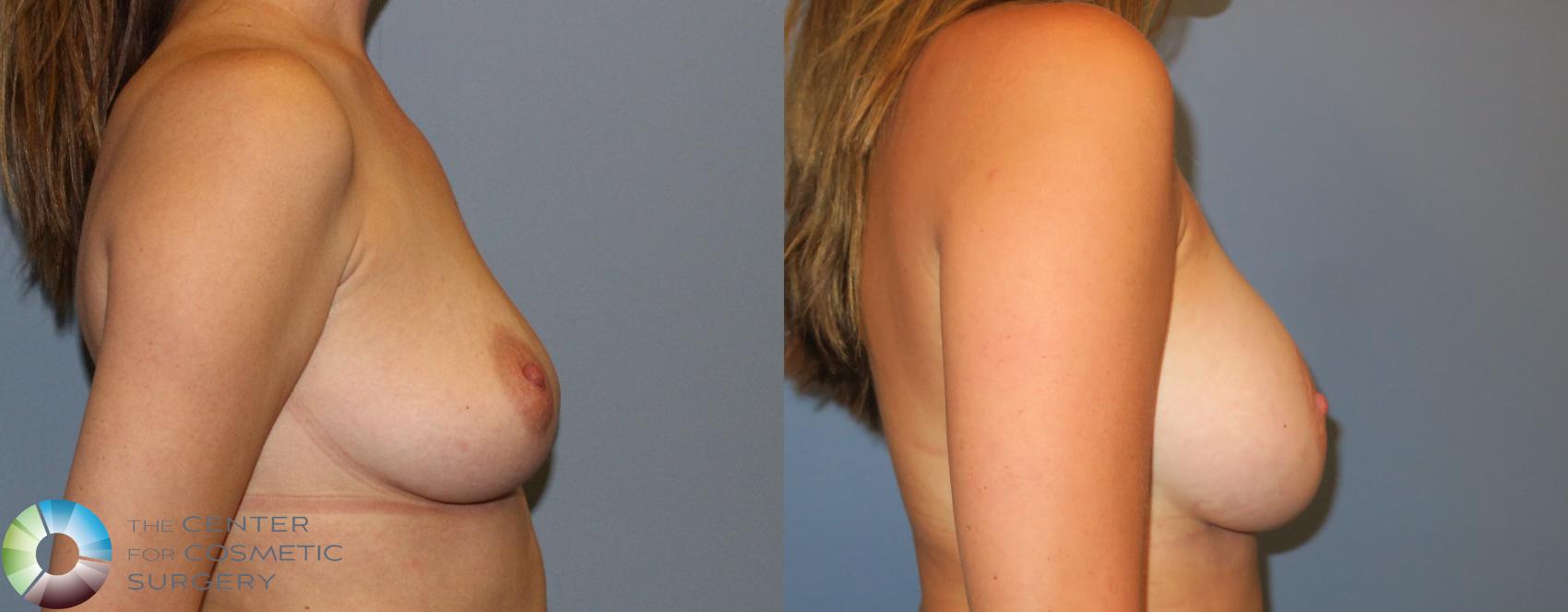 Before & After Breast Augmentation Case 803 View #3 in Denver and Colorado Springs, CO