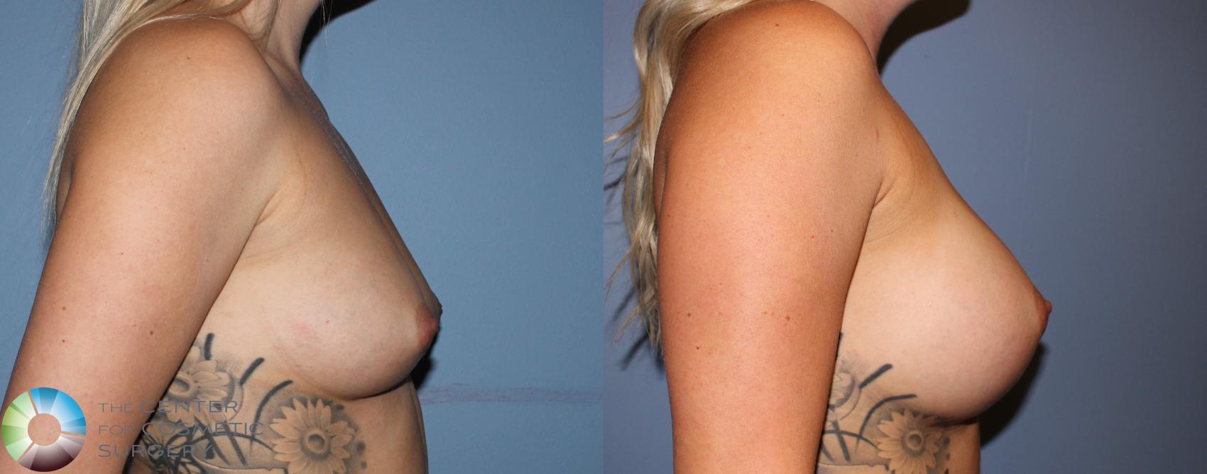 Before & After Breast Augmentation Case 804 View #1 in Denver and Colorado Springs, CO