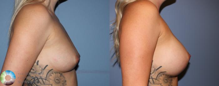 Before & After Breast Augmentation Case 804 View #1 View in Golden, CO