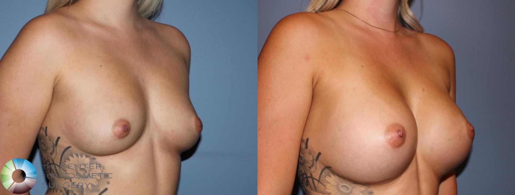 Before & After Breast Augmentation Case 804 View #2 View in Golden, CO