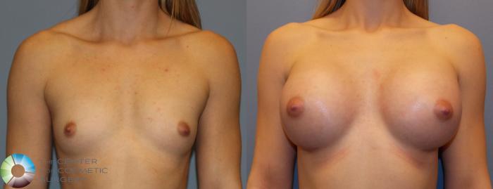 Before & After Breast Augmentation Case 805 View #1 in Denver and Colorado Springs, CO