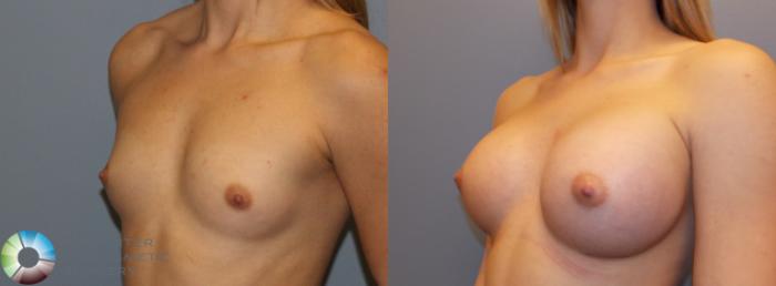 Before & After Breast Augmentation Case 805 View #2 in Denver and Colorado Springs, CO