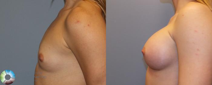 Before & After Breast Augmentation Case 805 View #3 in Denver and Colorado Springs, CO