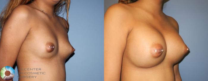 Before & After Breast Augmentation Case 809 View #2 View in Golden, CO