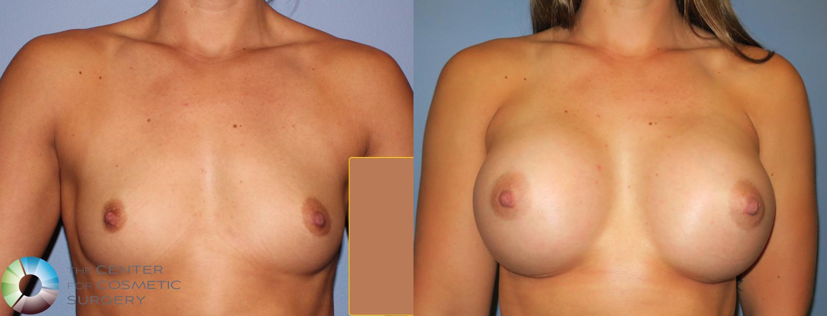 Before & After Breast Augmentation Case 811 View #1 in Denver and Colorado Springs, CO