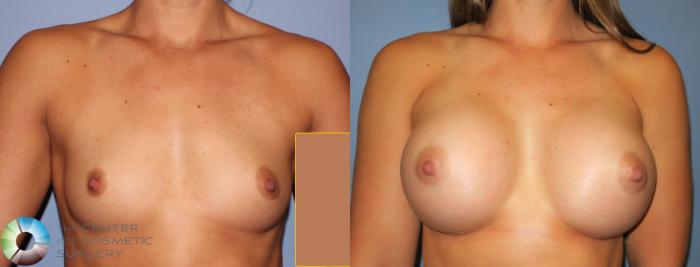 Before & After Breast Augmentation Case 811 View #1 View in Golden, CO