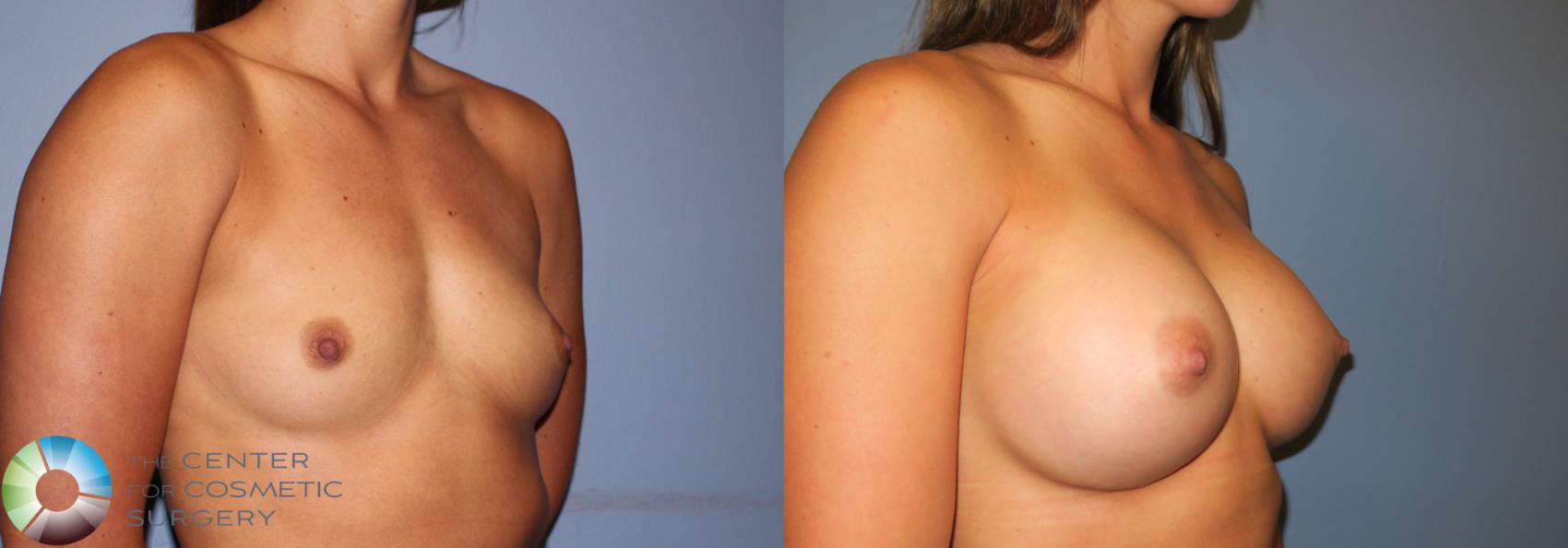 Before & After Breast Augmentation Case 811 View #2 in Denver and Colorado Springs, CO