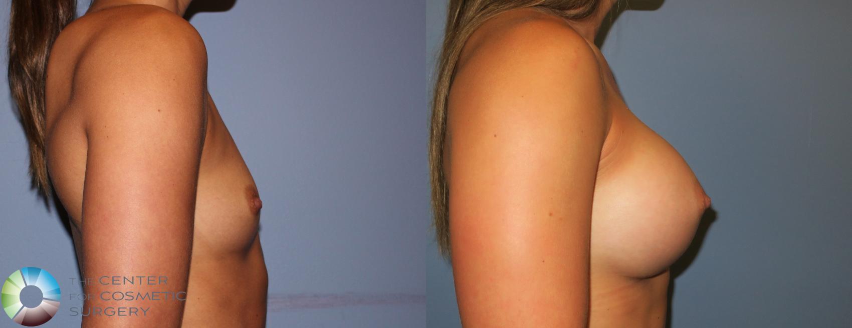 Before & After Breast Augmentation Case 811 View #3 in Denver and Colorado Springs, CO
