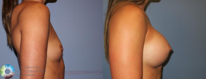 Before & After Breast Augmentation Case 811 View #3 View in Golden, CO