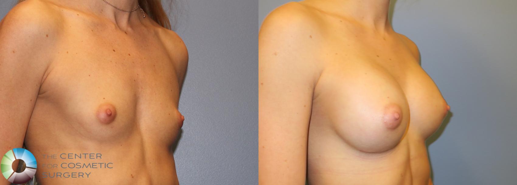 Before & After Breast Augmentation Case 828 View #1 in Denver and Colorado Springs, CO