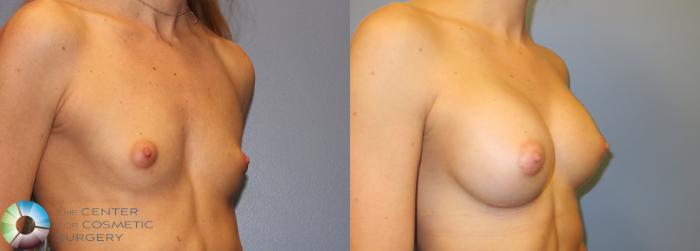 Before & After Breast Augmentation Case 828 View #1 View in Golden, CO