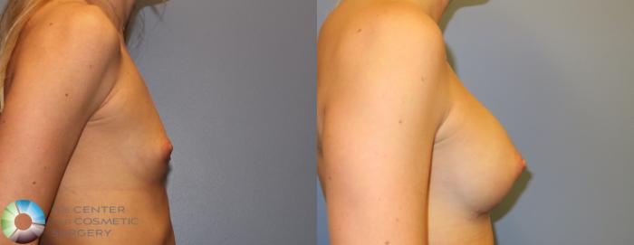 Before & After Breast Augmentation Case 828 View #2 View in Golden, CO