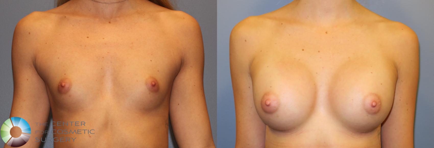 Before & After Breast Augmentation Case 828 View #3 View in Golden, CO