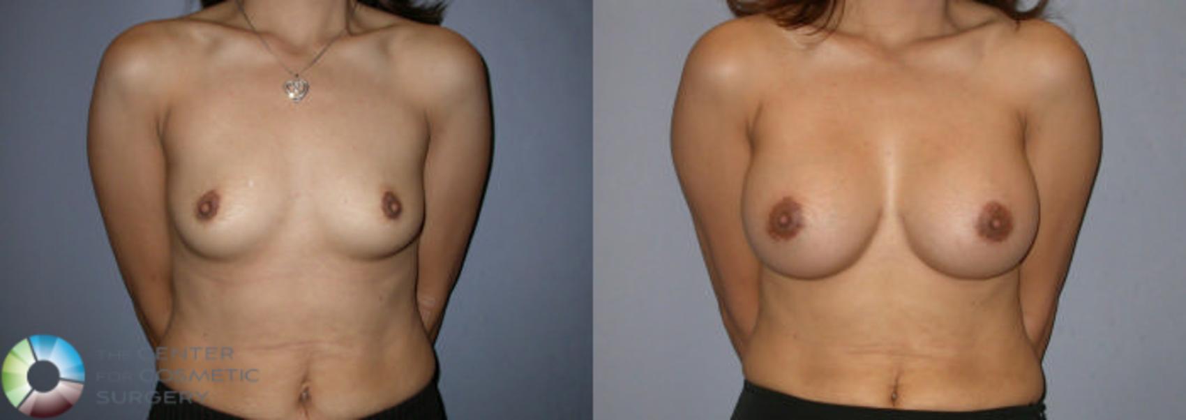 Before & After Breast Augmentation Case 83 View #1 in Denver and Colorado Springs, CO